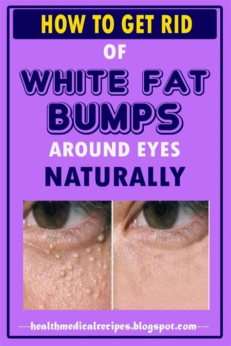 The Small White Bumps For Your Skin Which Typically Seem Around Your
