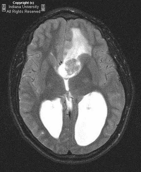 Neuroradiology On The Net Subependymal Giant Cell Astrocytoma