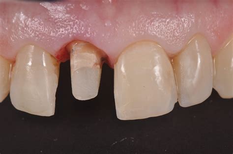 How To Get The Perfect Look With Diverse Tooth Restorations