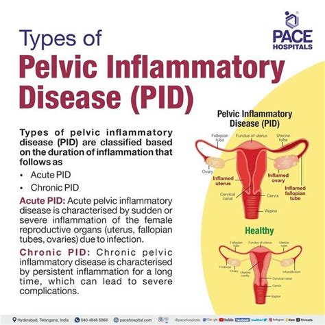 Pelvic Inflammatory Disease Pid Symptoms Causes Risk