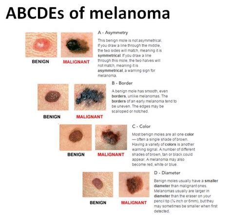 Nodular Melanoma Causes Symptoms Diagnosis And Treatm