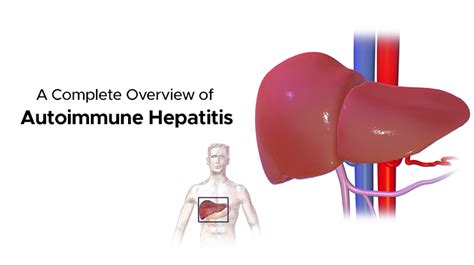 What Is Autoimmune Hepatitis Symptoms And Treatment Ailbs India