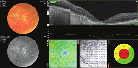 Dry Form Geographic Atrophy Of Age Related Macular Degeneration