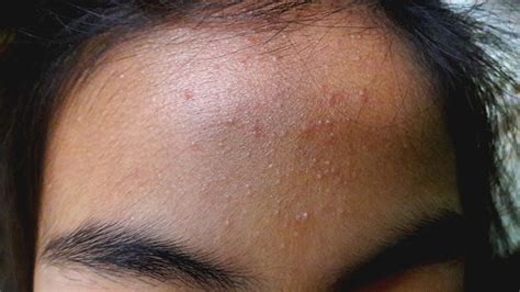 Acne Or Pityrosporum Folliculitis Can Dermoscopy Can Help Diagnose