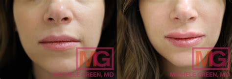 Restylane Vs Juvederm For Lips Face Under Eyes Dr Michele Green Md