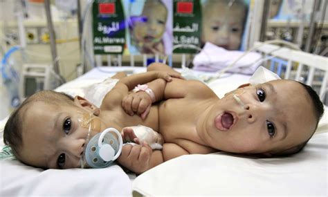 Conjoined Twins Born At San José Hospital