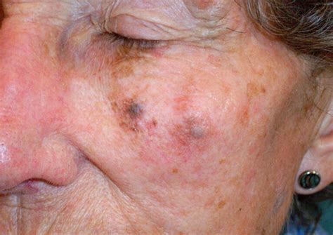 Cancerous Moles On Face Pictures Symptoms And Pictures