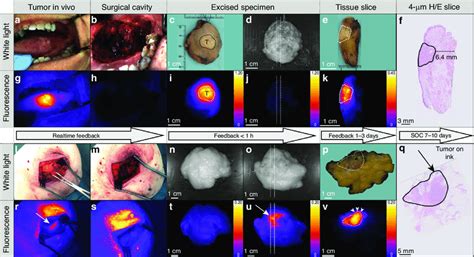 Fluorescence Guided Assessment Of Surgical Margins Representative
