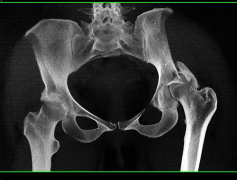Acetabular Fracture With Hip Dislocation And Multiple 2d And 3d
