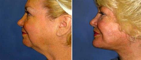 Patient 38566797 Neck Lift Before And After Photos Cosmeticare