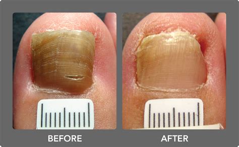 What Is The Best Toenail Fungus Treatment