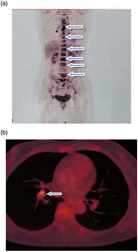 A Positron Emission Computed Tomography Pect Showing Bone Lesions