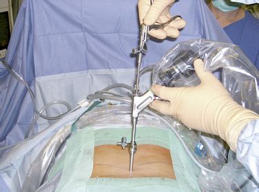 Full Endoscopic Interlaminar Lumbar Discectomy And Spinal Decompression Clinical Gate