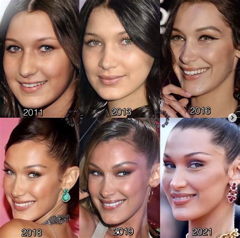 bella hadid plastic surgery bella before and after surgery