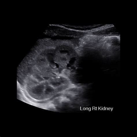 Newborn With Abnormal Prenatal Ultrasound Pediatric Radiology Case
