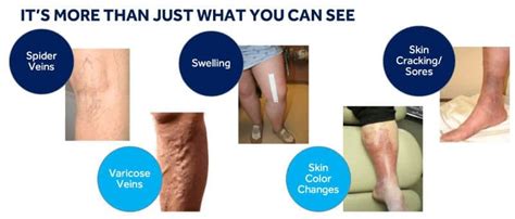 Burning Legs It Could Be A Venous Disorder Heres What You Need To Know