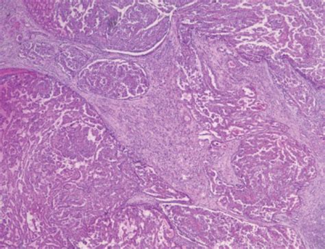 Metastatic Tfe3 Overexpressing Renal Cell Carcinoma Case Report And