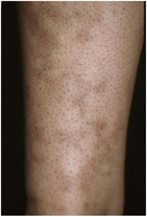 Mottled Skin After A Shower With Lupus Should You Be Concerned