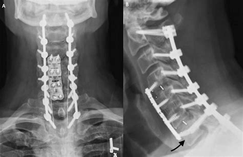 Cureus Safety And Accuracy Of The Freehand Placement Of C7 Pedicle