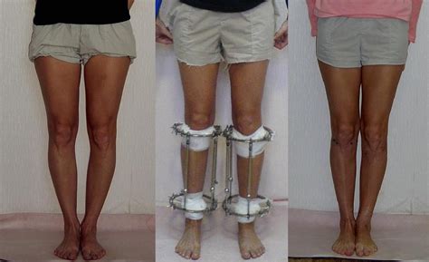 Pin On Leg Or Limb Lengthening Surgery