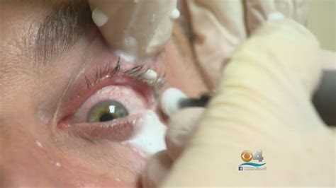 26 Best Eye Mites In Humans Demodectic Mange