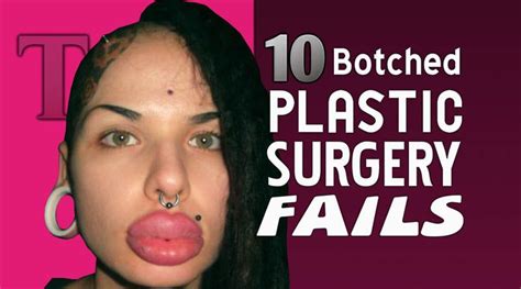 Our Top Ten List Of Botched Plastic Surgery Fails Has The Most Shocking Before And After Photos