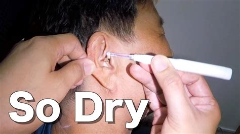 Mans Dry Scaly Earwax Removed From Both Ears Youtube