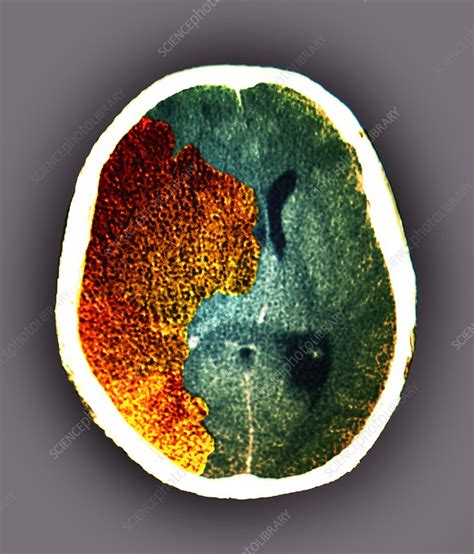 Stroke And Brain Damage Ct Scan Stock Image C0474969 Science