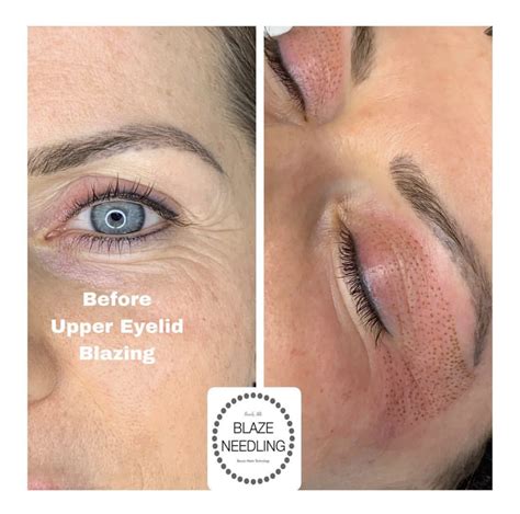 Upper eyelid blepharoplasty is a surgical procedure created to rejuvenate the appearance of the dr. Fibroblast Blaze Needling | Bevely Hills