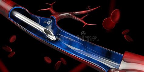 3d Illustration Of Injection In The Vein On Black Background Stock