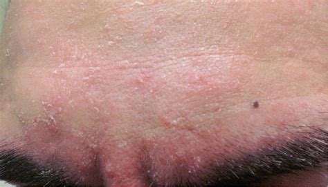 Seborrheic Dermatitis Chest Mild
