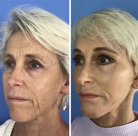 Facial Fat Grafting Benefits For A Youthful Results