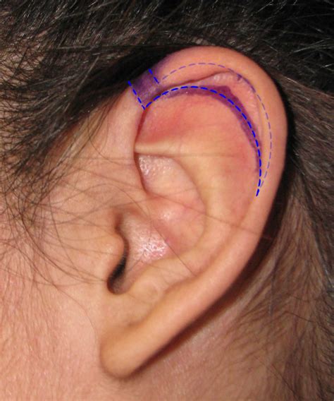Macrotia Ear Otoplasty Surgery To Reduce Large Prominent Ears