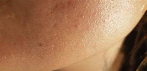 Skin Concerns Hard Bumps And Grainy Texture All Over