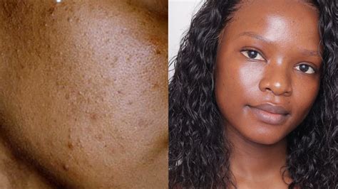 How I Cleared My Skin Dark Spots Mild Acne And Hyperpigmentation