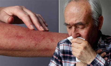Coronavirus Symptoms Signs Of Covid 19 Infection Include Rash On Your