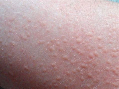 Effective Ways To Get Rid Of Hives