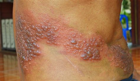 Infections are categorized based on the part of the body infected. Where Do Shingles Appear on the Body? Most Common ...