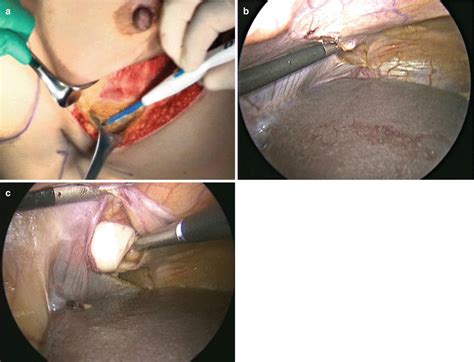 Breast Reconstruction Using Laparoscopically Harvested Omental Flap