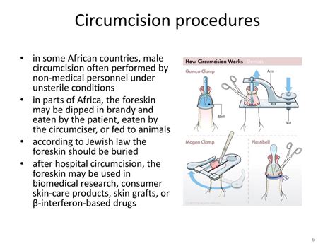 Ppt Circumcision And Vasectomy Powerpoint Presentation Free Download