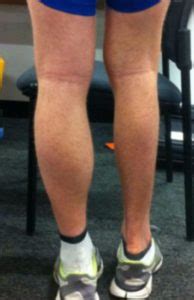 Some of the most common areas of injury in runners are the ankle and achilles tendon. Calf Muscle Atrophy After an Achilles Tendon Rupture | Achilles Tendon Rupture