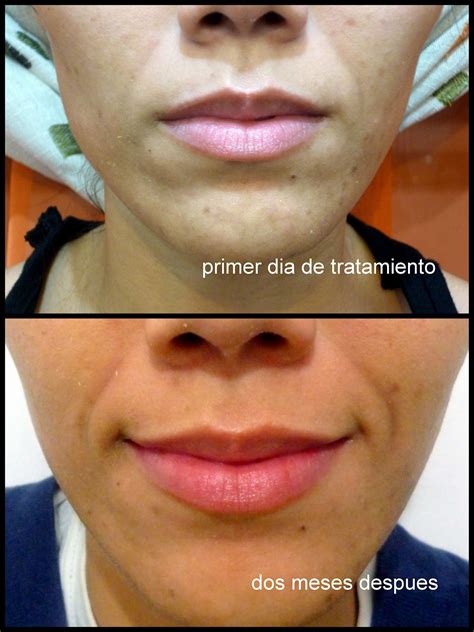 EXPERIENCIA CON COSAS COTIDIANAS: MIS AVANCES CON DIACNEAL DE AVÈNE