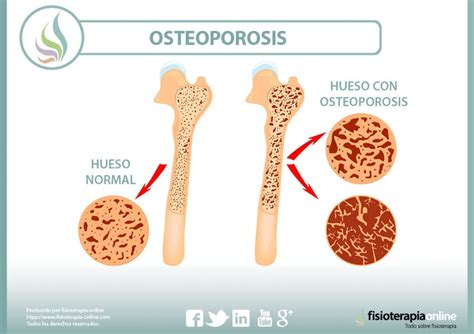Osteoporosis Qué Es Causas Síntomas Tratamiento Y Consejos