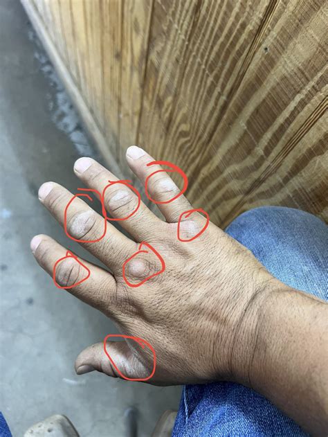 Dry And Thick Knuckles Rdermatologyquestions