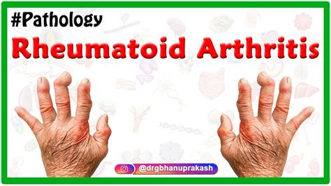 Rheumatoid Arthritis Animation Etiology Signs And Symptoms Pathology Diagnosis And