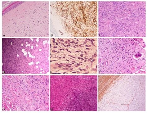 Dermatofibrosarcoma Protuberans By Brian Schulte