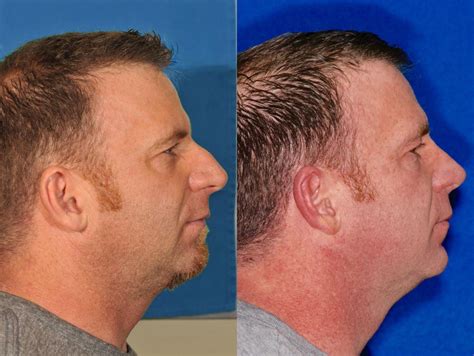 Rhinoplasty Before And After 9 Jesse E Smith Md Facs Ft Worth