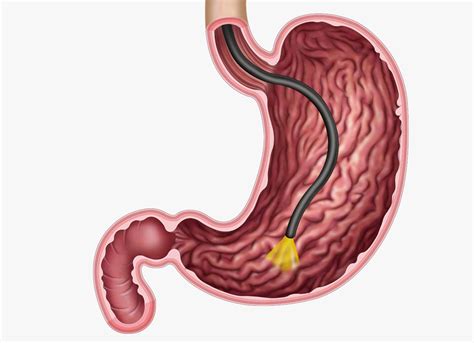 Gastroscopy Oxford Gut And Liver
