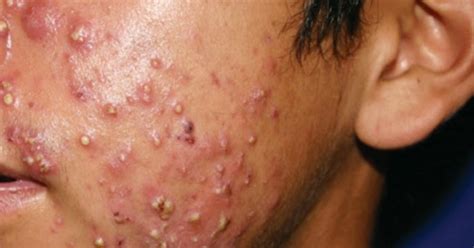 Cystic Acne Causes Natural Treatment And Prevention All About Health