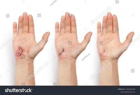 1567 Hand Laceration Images Stock Photos And Vectors Shutterstock
